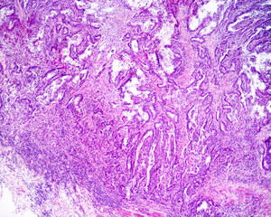 Gastric carcinoma