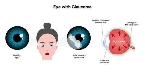 Healthy eye and eye with glaucoma. Ophthalmology eye anatomy. Inflammatory glaucoma