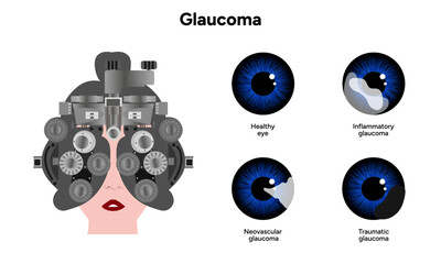 Healthy eye and eye with glaucoma. Ophthalmology eye testing. Inflammatory glaucoma. Neovascular glaucoma. Traumatic glaucoma