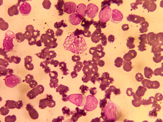 Chronic myeloid leukemia cells or CML, analyze by microscope. Blood cancer cells image.