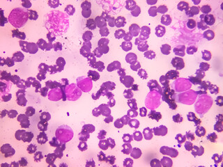 Chronic myeloid leukemia cells or CML, analyze by microscope. Blood cancer cells image.