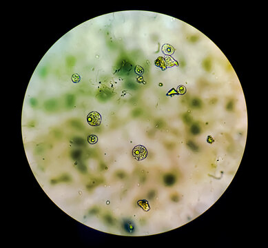 Trichomonas vaginalis in urine sediment analysed by microscope. It's a preventable and curable sexually transmitted protozoan that infects the urogenital tract.