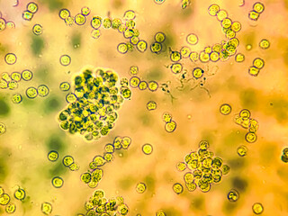 WBC or Pus cells cast in urine sediment analyzed by microscope. medical and healthcare conceptional...