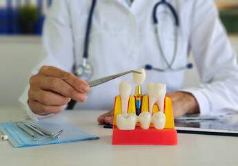 Doctor hold dental implant, artificial tooth roots into jaw, root canal of dental treatment, gum...