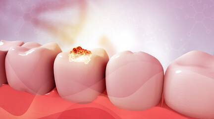 Human tooth disease. 3d illustration..