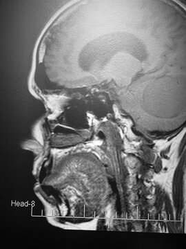Image d'imagerie par r&eacute;sonance magn&eacute;tique (IRM) du cerveau humain.
