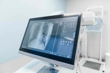 Close up of x-ray image of human chest lungs shown on the monitor screen modern laboratory...