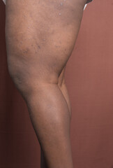 Eczema on brown skin leg, brown skin with hyperpigmentation and scarring from eczema and atopic...