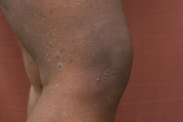 Eczema on brown skin, atopic dermatitis and prurigo nodularis on brown skin leg, eczema breakout on dark skin
