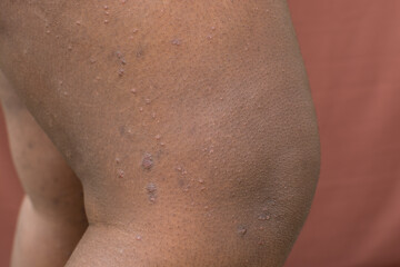 Eczema on brown skin, atopic dermatitis and prurigo nodularis on brown skin leg, eczema breakout on...