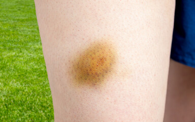 Close-up of a bruise on the leg of a female soccer player or athlete after a blow in a stadium