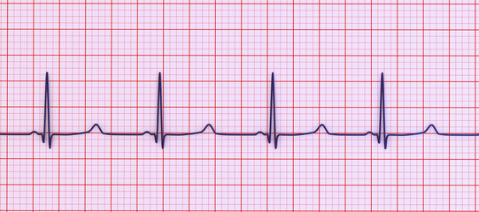 ECG of type 3 long QT syndrome, 3D illustration