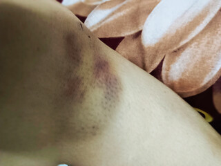 Fototapeta premium Bruises appear on the skin without being hit by a hard object