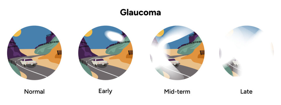 Healthy eye and eye with glaucoma. Inflammatory glaucoma. Neovascular glaucoma. Traumatic glaucoma