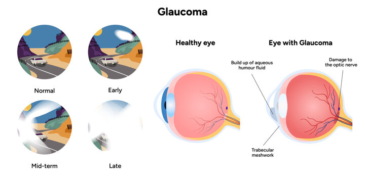 Healthy eye and eye with glaucoma. Eye anatomy. Early, mid-term and late glaucoma