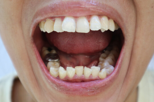 Amalgam filling inside of a woman's mouth. crown filling of amalgam in the molars.