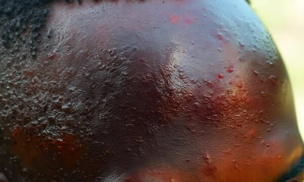 Close-up View of Severe Acne and Skin Irritation on the Forehead