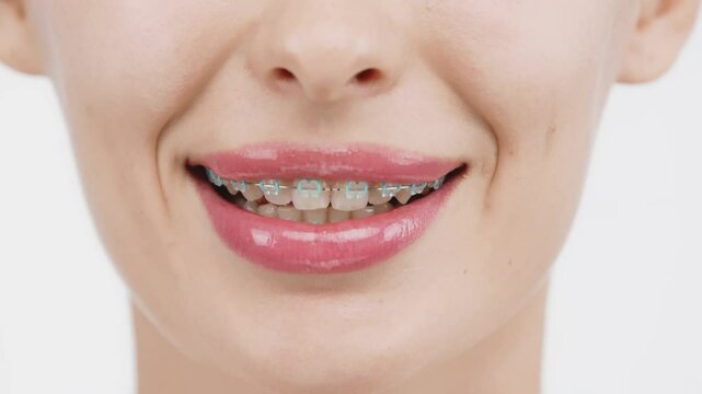 A close-up of a woman's teeth with full lips and braces. She smiles, showcasing her commitment to oral hygiene and confidence in her smile.