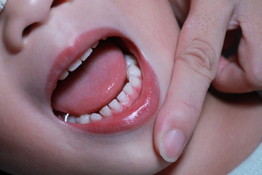Milk teeth.