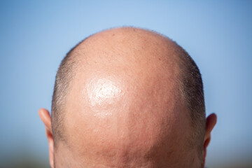 Bald head man, back of head, baldness, hair transplant, hair loss. Hair loss close-up.