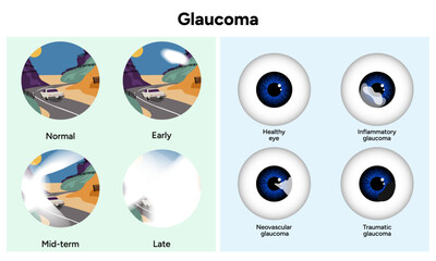 Healthy eye and eye with glaucoma. Inflammatory glaucoma. Neovascular glaucoma. Traumatic glaucoma. Early, mid-term and late glaucoma