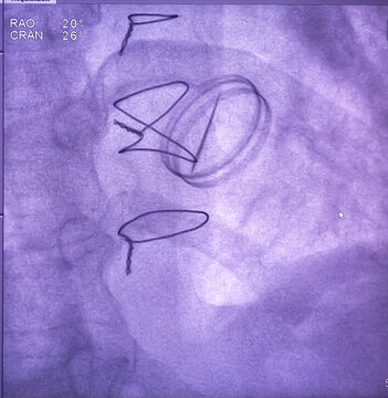 X ray image of heart valve. severe nefriction of mechanical mitral prosthetic valve.