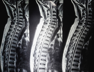 MRI scan of cervical spine (C-spine) : Nerve root compression and cervical spondylosis, herniation....
