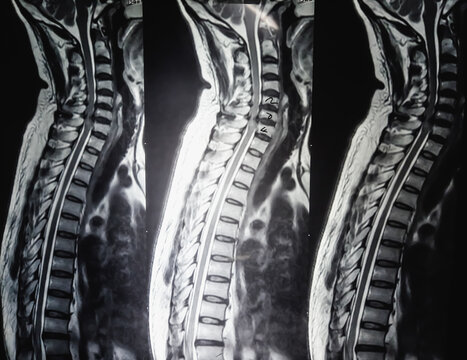 MRI scan of cervical spine (C-spine) : Nerve root compression and cervical spondylosis, herniation. Medical image concept.