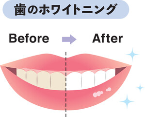 歯のホワイトニング