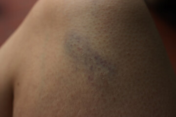 Close-up of a bruise on a young man's leg on selective focus
