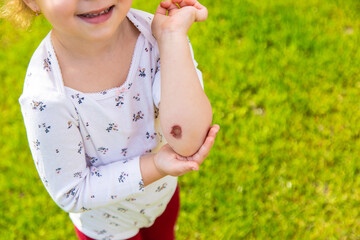 Child wound on hand. Selective focus.