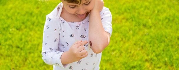 Child wound on hand. Selective focus.