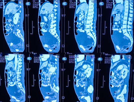 Image show CT whole abdomen with contrast. Findings huge ascites, pleural effusion, collapsed lower lobe of left lung, secondary stage of liver.