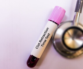 Blood sample for clot retraction test, to measures the time taken for a platelet plug to undergo...
