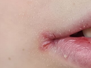 Fototapeta premium Close-up view of inflamed skin around the lip area, highlighting skin irritation and potential infection