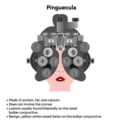 Ophthalmology. Pinguecula information and infographic 