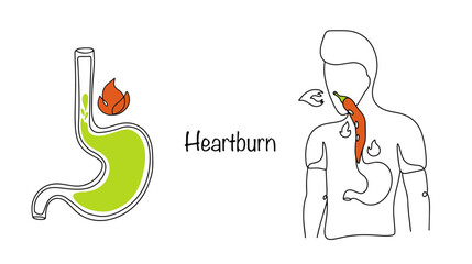 Heartburn