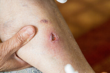 Fototapeta premium Deep 1 cm size wound on a old woman's leg