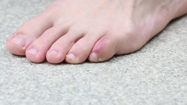 Foot with swollen stubbed pinky toe moving uncomfortably 