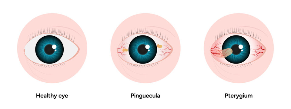 Optometry appointment healthy eye pinguecula and pterygium