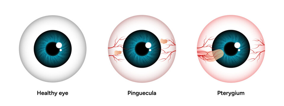 Optometry appointment healthy eye pinguecula and pterygium