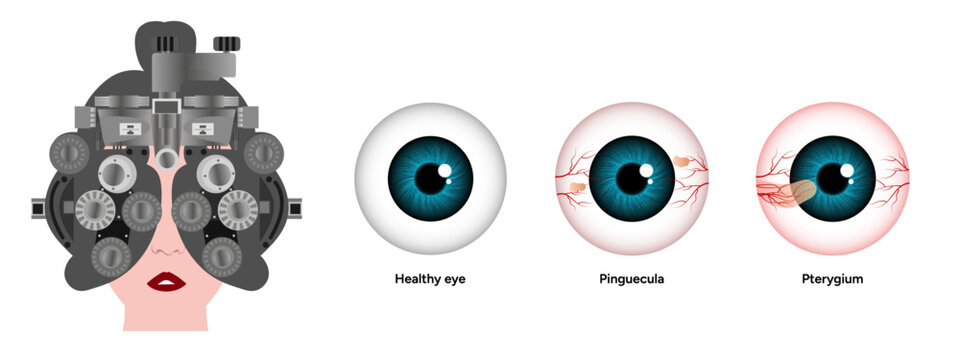 Optometry appointment healthy eye pinguecula and pterygium