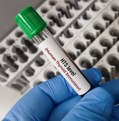 Blood sample for Thyroid stimulating Immunoglobulin (TSI) test. Throtropin binding inhibitory...