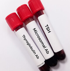 Blood sample for Thyroid Peroxidase Antibodies or Anti-TPO test and anti-Tg Test. Thyroid function tests, to diagnosis of hypothyroidism and thyroiditis.