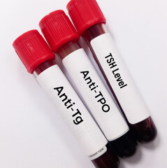 Blood sample for Thyroid Peroxidase Antibodies or Anti-TPO test and anti-Tg Test. Thyroid function tests, to diagnosis of hypothyroidism and thyroiditis.