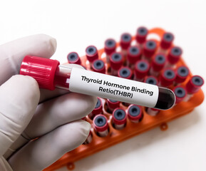Obraz premium Blood sample for Thyroid Hormone–Binding Ratio (THBR) or THBI or T3 resin uptake(T3RU) test. Thyroid function tests to diagnosis of hyperthyroidism or hypothyroidism of a patient.
