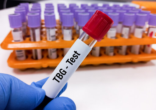 Blood sample for TBG (Thyroxine-binding globulin) test. Thyroid function tests to diagnosis of hyperthyroidism or hypothyroidism of a patient.