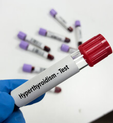 Naklejka premium Blood sample for Thyroid Peroxidase Antibodies or Anti-TPO test and anti-Tg Test. Thyroid function tests, to diagnosis of hypothyroidism and thyroiditis.
