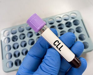 Chronic Lymphoblastic Leukemia (CLL) blood test. Blood cancer.