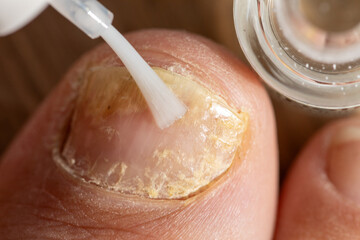 Treating toenail fungus with medication